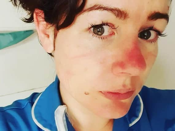 Rachel Holme shows off her "Covid nose" - caused by wearing PPE during a full 12-hour shift.
