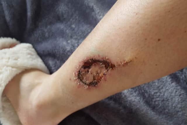 Lauren's scar on her leg following a skin graft to eliminate her cancer.
