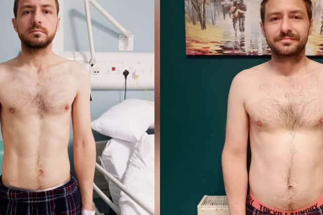 Dave Fisher before and after starting his new drug treatment, having put on 7kg.