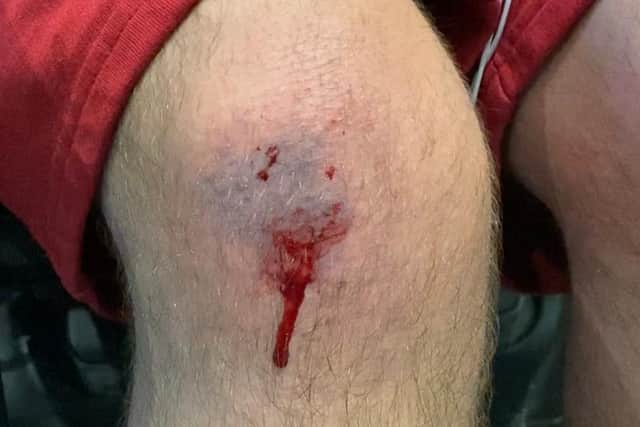 Cameron Redpath suffered bruising and cuts to his knee and hand after he was tipped out of his wheelchair on Quernmore Road in Lancaster after he hit an uneven paving slab.