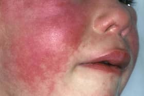 A case of scarlet fever has been confirmed at a Lancashire primary school.