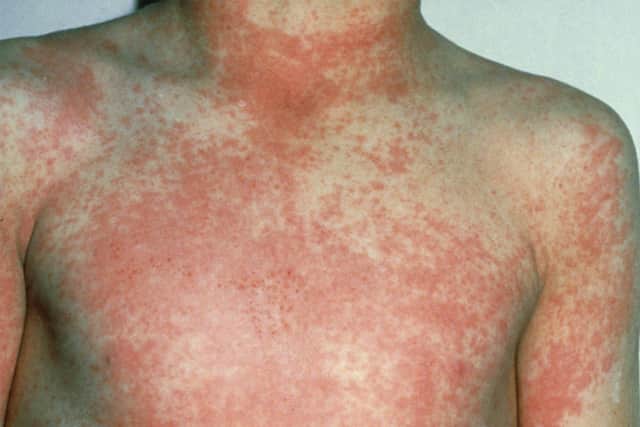 The NHS says the rash looks pink or red on white skin and may be harder to see on brown and black skin, but you can still feel it