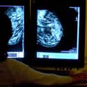 Cancer Research UK says it has been sounding the alarm on the importance of early cancer diagnosis for years.