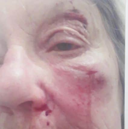 The injuries caused to the pensioner's face.
