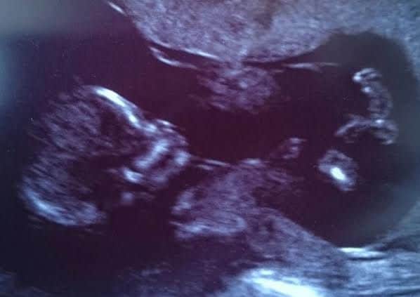 Rebecca Peaks baby scan. The gender of the baby is unknown.