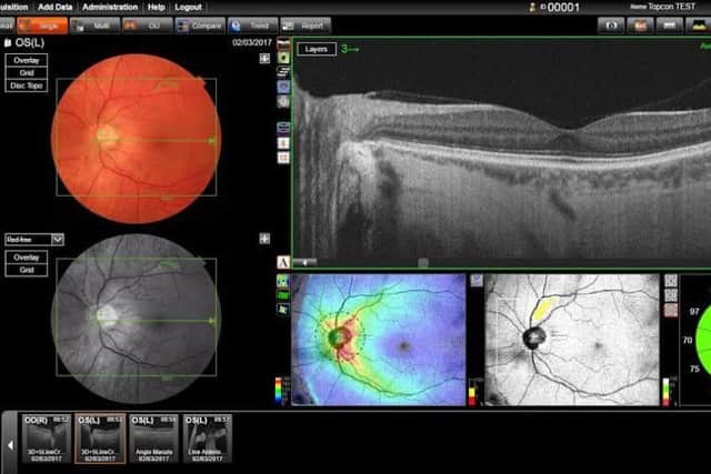 Gayle's eye scan using the new 3D OCT screening machine at Philip Jones Opticians in carnforth.